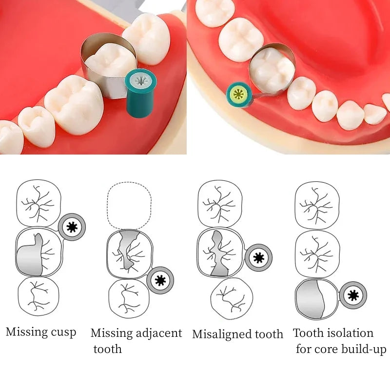 50Pcs/box Dental Matrix Bands Steel Matrix Double-Side Contoured Anatomically Shaped Matrix Bands Knob Type Matrix For Dentistry